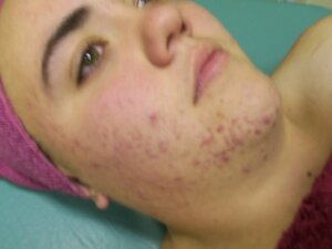 Acne help